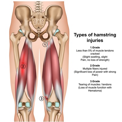 What is Muscle Spasm? - Brisbane Physiotherapy